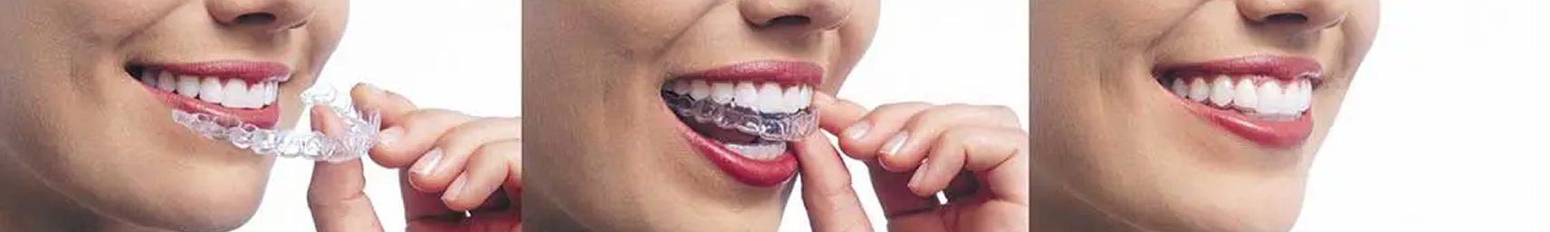 Invisalign braces
