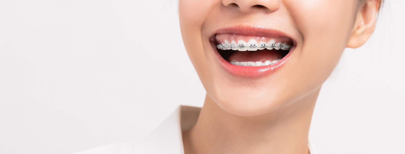 braces orthodontics