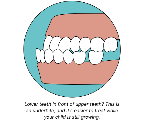Graphic of an underbite in kids